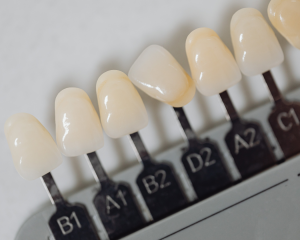 Veneers